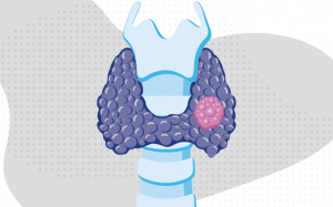 Nhân tuyến giáp 5mm có nguy hiểm không?