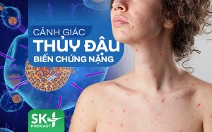 Podcast: Cảnh giác thủy đậu biến chứng nặng