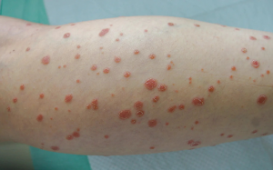 Cách đối phó với bệnh vảy nến thể giọt