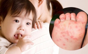 Điều trị tay chân miệng an toàn, tránh biến chứng cho trẻ