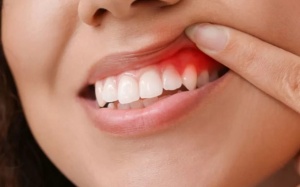 Dấu hiệu cảnh báo sớm viêm quanh răng và biện pháp cải thiện