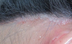 Vảy nến da đầu có phải gàu không?