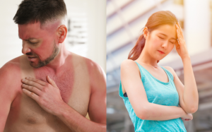Làm thế nào để phân biệt cháy nắng và ngộ độc ánh nắng mặt trời?