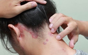 Bệnh vảy nến da đầu có lây không?