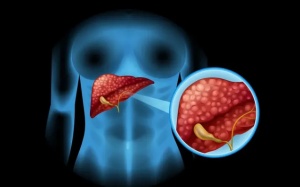 Mắc sỏi mật có làm tăng nguy cơ ung thư túi mật?