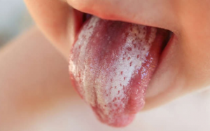 Bệnh nấm miệng: Nguyên nhân, triệu chứng và cách chăm sóc 