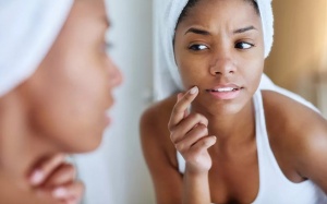 Bác sĩ da liễu chỉ cách ngăn ngừa mụn trong mùa Hè