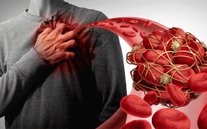 Sau khi điều trị cục máu đông có nên tập thể dục?