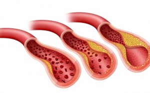 Thiểu năng mạch vành là gì và có điều trị khỏi được không?