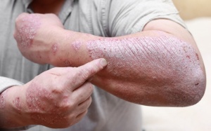 Vảy nến không điều trị sớm có thể gây nhiều biến chứng nguy hiểm