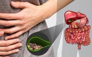 Làm sao ngăn sỏi túi mật 18mm gây triệu chứng?