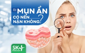 Podcast: Bị mụn ẩn có nên nặn không?
