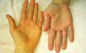 Dấu hiệu cảnh báo gan đang mất dần chức năng