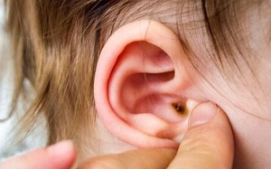  Cảnh giác biến chứng nguy hiểm của bệnh viêm tai giữa