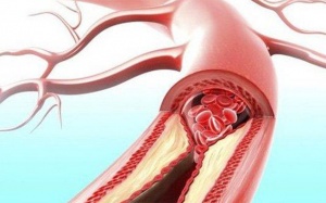 Hẹp mạch vành nhẹ, thỉnh thoảng đau ngực nên điều trị thế nào?