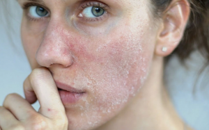 6 lý do khiến da bị khô