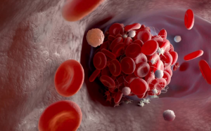 Điều gì gây ra cục máu đông ở người trẻ tuổi?