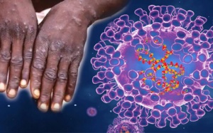 WHO ban bố tình trạng khẩn cấp toàn cầu lần thứ 2 vì bệnh đậu mùa khỉ