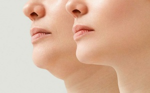 Có cách nào xóa bỏ nọng cằm?