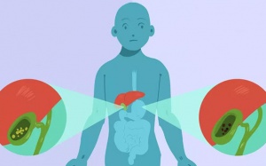 Nhiều viên sỏi mật 8 - 9mm uống TPBVSK Kim Đởm Khang được không?