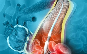 Tái hẹp động mạch vành sau đặt stent phải làm sao?