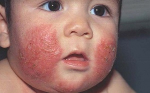 Trẻ béo phì có nguy cơ mắc bệnh chàm và vảy nến cao hơn