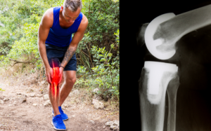 Vì sao bệnh nhân phẫu thuật thay khớp ngày càng trẻ hóa tại Mỹ?