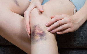 Nguyên nhân nào khiến cơ thể bạn dễ bầm tím?