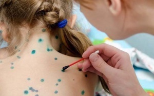 4 thực phẩm có ích cho người bị bệnh thủy đậu