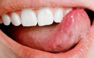 Tình trạng lưỡi nói lên điều gì về sức khoẻ của bạn?