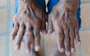 Nguyên nhân gây hạt tophi ở người mắc bệnh gout