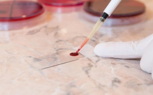 Xét nghiệm máu có thể dự đoán nguy cơ mắc bệnh tim mạch ở phụ nữ