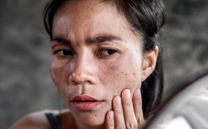 Hướng dẫn tự kiểm tra da giúp phát hiện sớm ung thư da