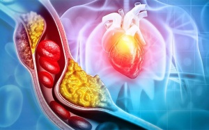 Làm sao để giảm tình trạng tắc hẹp mạch vành hiệu quả?