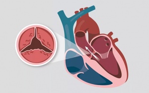 Hẹp van tim là gì và có những nguyên nhân nào gây hẹp van tim?