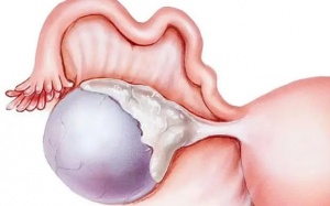 Dấu hiệu nhận biết u nang nhầy buồng trứng