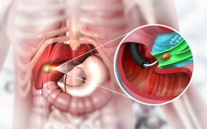 Xử trí thế nào khi bị viêm túi mật?