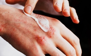 Biện pháp chăm sóc da tự nhiên cho người mắc bệnh chàm eczema