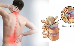 Thoát vị đĩa đệm cột sống thắt lưng - Nguyên nhân và cách cải thiện tại nhà