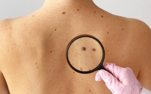 Những yếu tố làm tăng nguy cơ ung thư da, dấu hiệu nhận biết? 