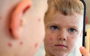 Cách cải thiện triệu chứng ngứa ngáy do sởi