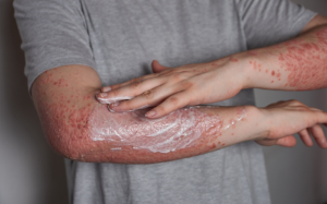 Cảm giác sẽ thế nào khi “sống chung” với bệnh vảy nến?