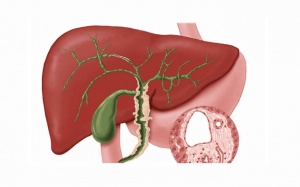 Sỏi gan 7mm: Nên mổ hay dùng cách tẩy sỏi gan 1 ngày?