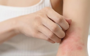 Mách bạn cách đối phó với phát ban do căng thẳng