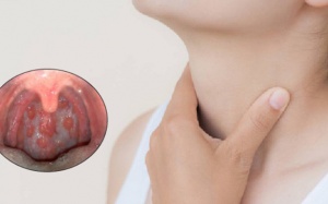 Dấu hiệu nhận biết sớm viêm họng hạt bạn nên biết