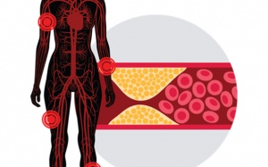 Đái tháo đường: Biến chứng mạch máu nhỏ làm tăng nguy cơ mù lòa, suy thận