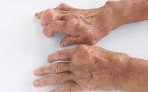 Cảnh báo những biến chứng gout nguy hiểm và cách phòng ngừa