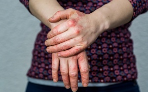 Biện pháp giảm cứng khớp do viêm khớp vảy nến