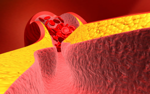 Biến chứng khó lường do mỡ máu cao và cách phòng ngừa từ thảo dược