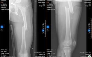 BV Nhi Hà Nội: Phẫu thuật gãy xương đùi bằng phương pháp xâm lấn tối thiểu